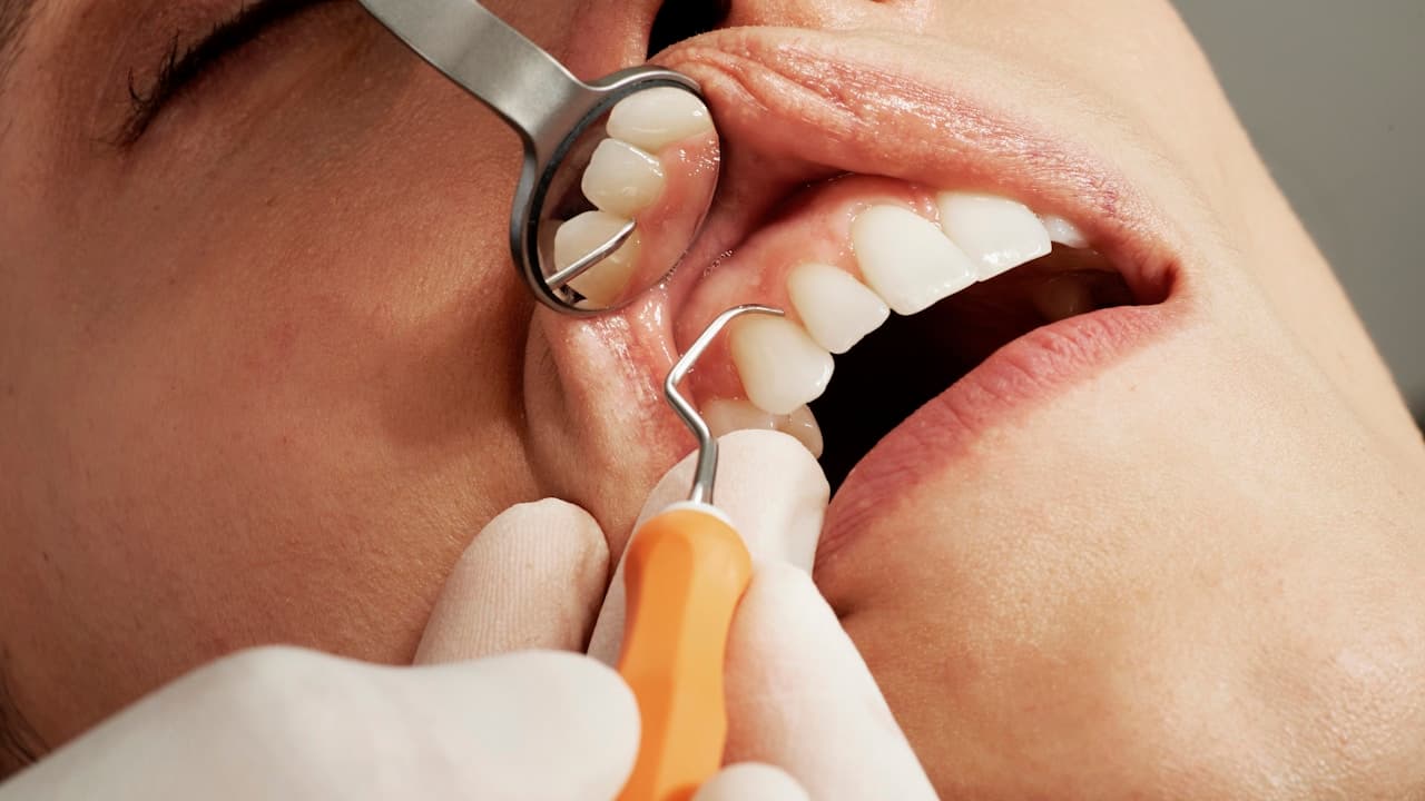 All-on-4 Dental Implants in Puerto Vallarta: Everything US Patients Need to Know